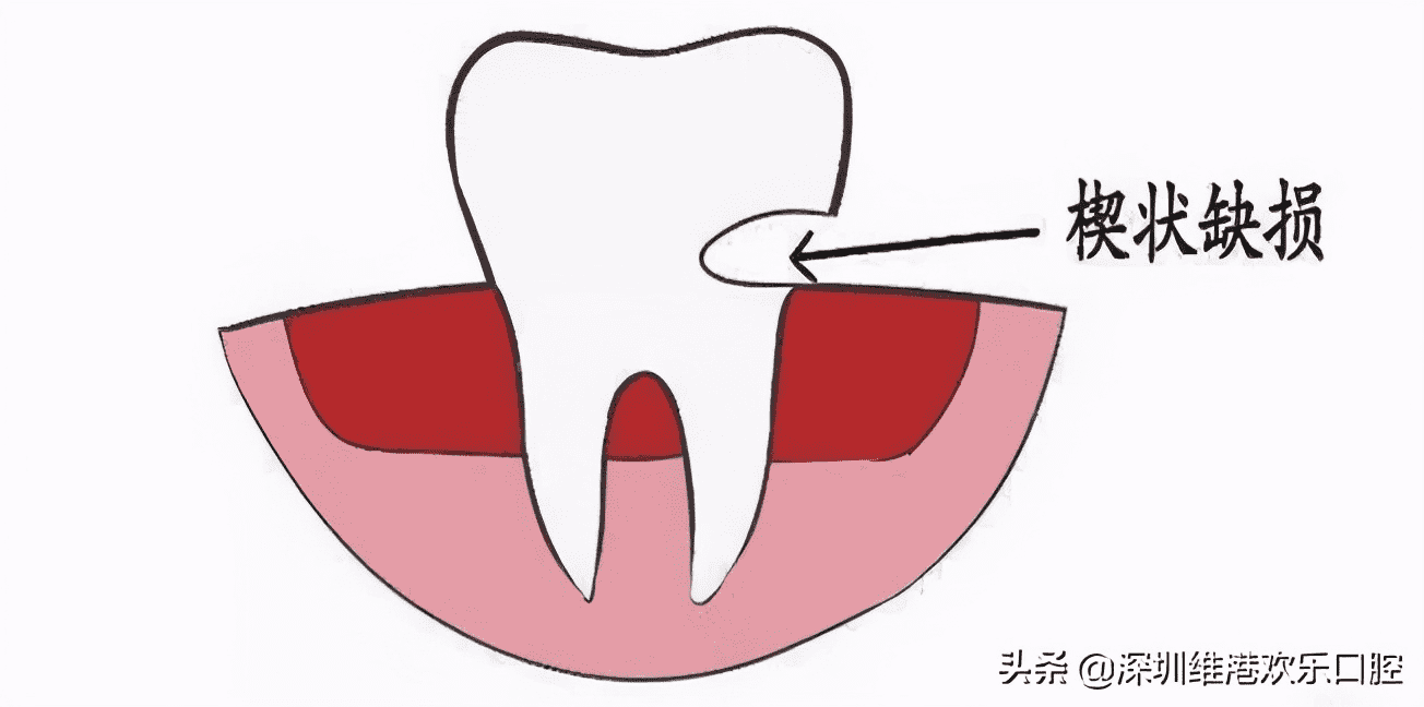 最简单的处理断牙的方法（牙齿缺失、断掉怎么办？这些修复方法你知道吗？） 